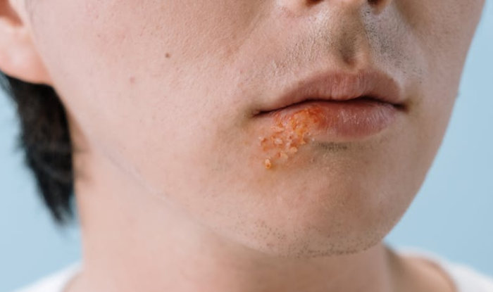 herpes simplex